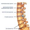 Межпозвоночная грыжа